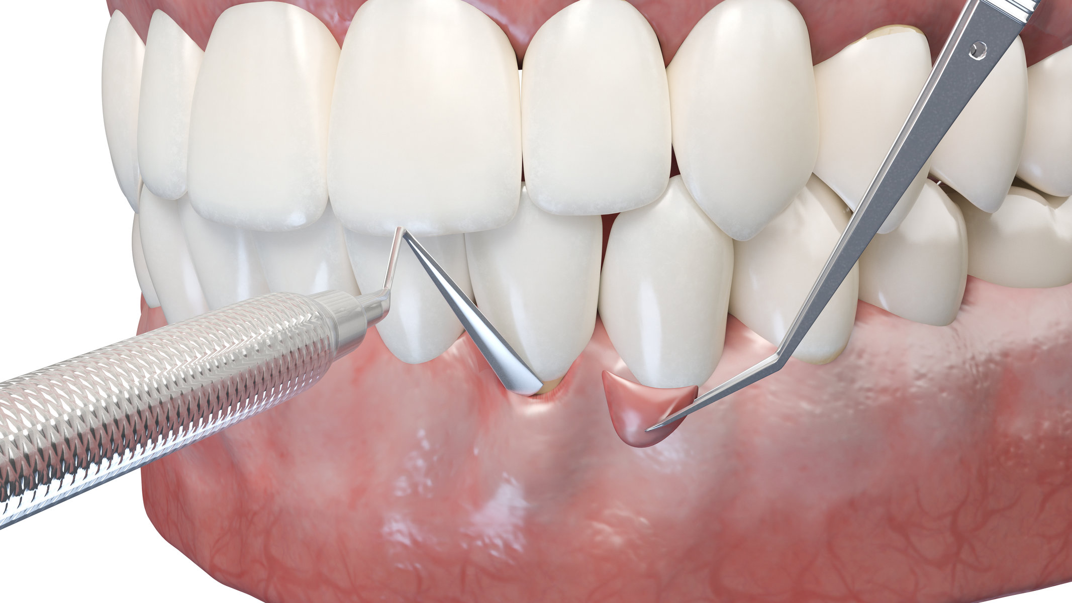 3d rendered illustration of a gum graft surgery