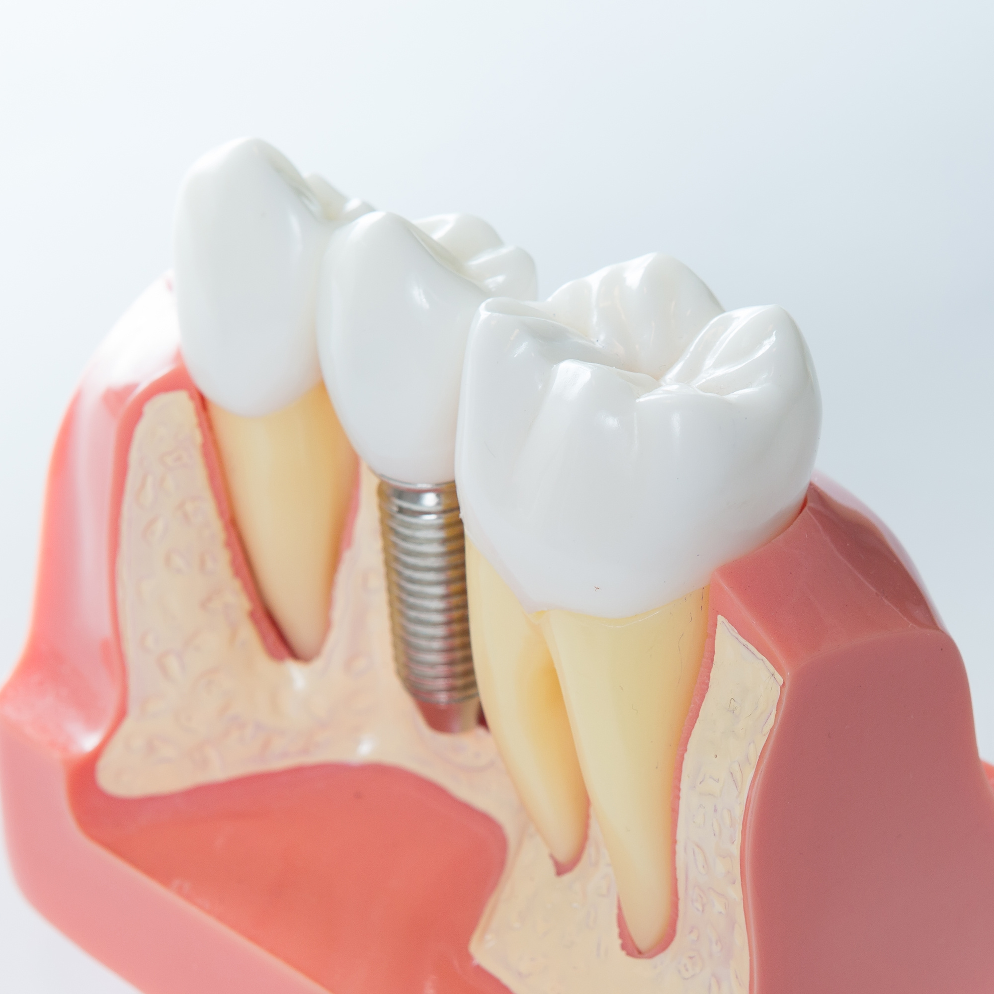 Close up of a Dental implant model. Selective focus.